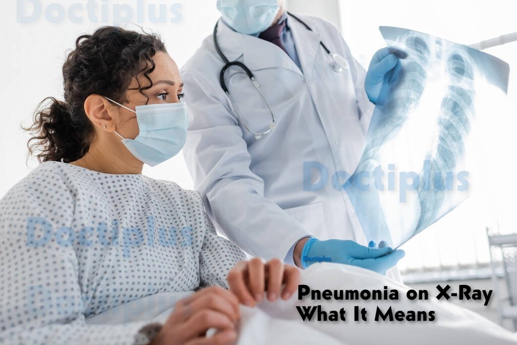 Pneumonia on X-Ray and What It Means