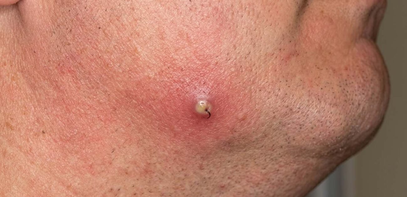 Close-up of an infected ingrown hair with redness and swelling
